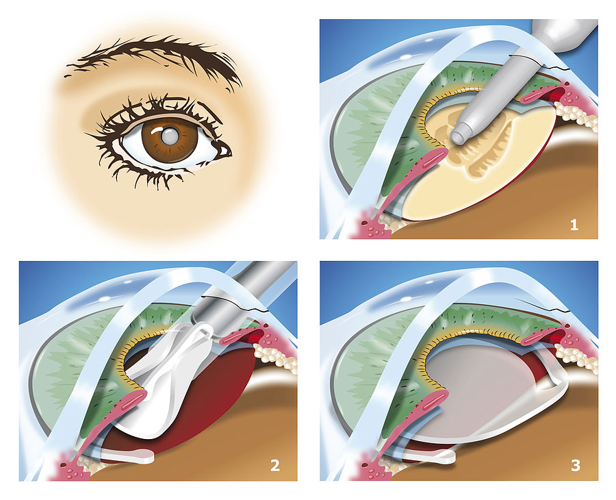 chirurgie-cataracte01